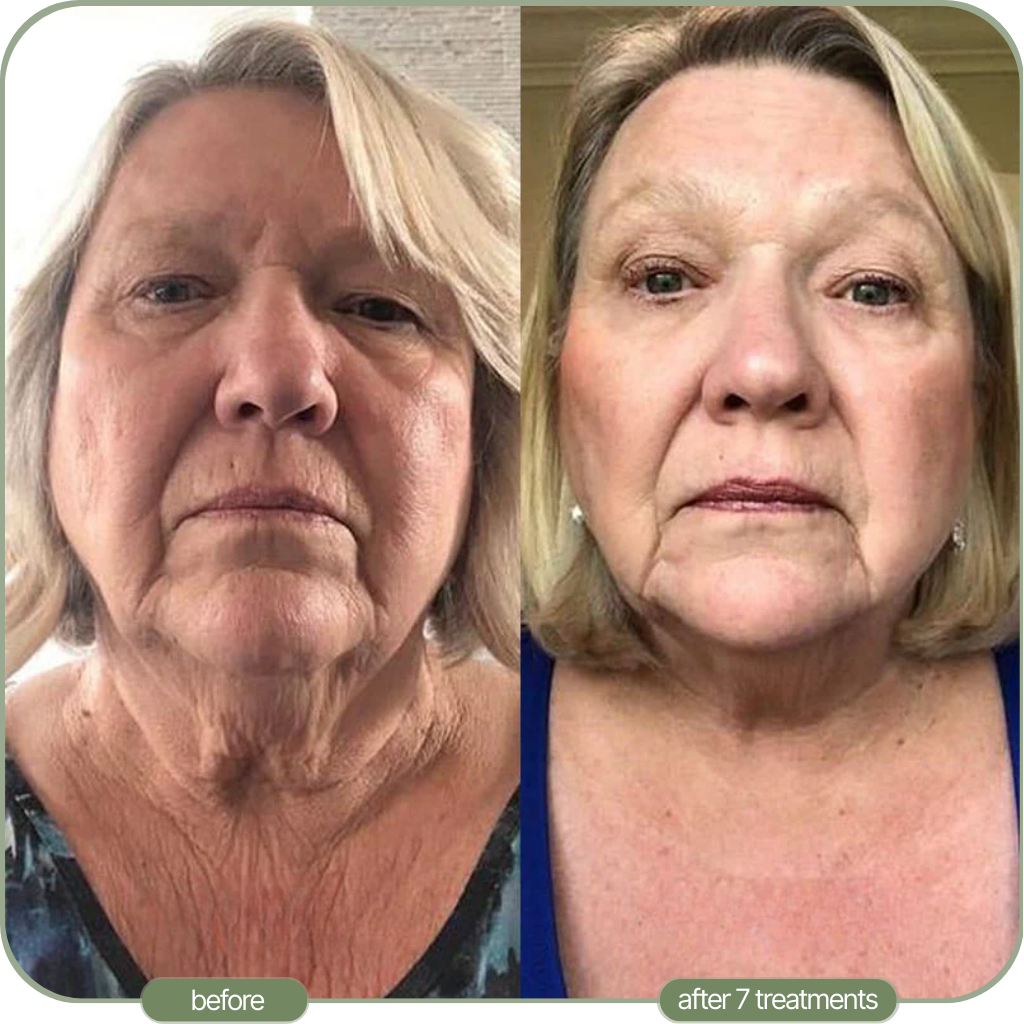 Ditch The Make-up: Embrace a New Level of Confidence with Micro-Infusion