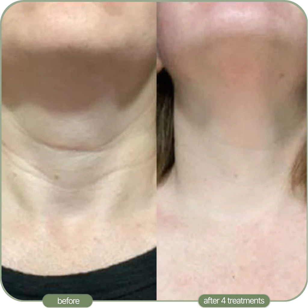 Ditch The Make-up: Embrace a New Level of Confidence with Micro-Infusion
