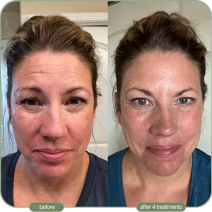 Ditch The Make-up: Embrace a New Level of Confidence with Micro-Infusion