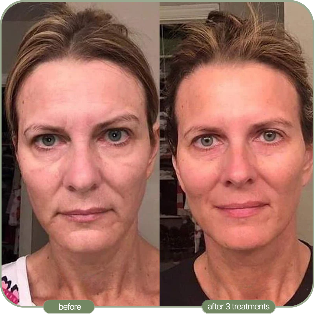 Ditch The Make-up: Embrace a New Level of Confidence with Micro-Infusion