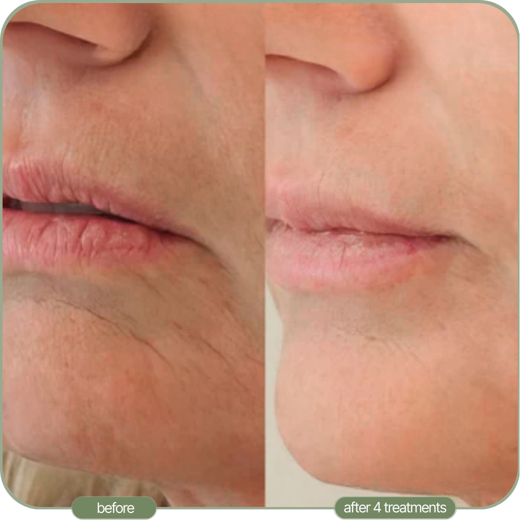 Ditch The Make-up: Embrace a New Level of Confidence with Micro-Infusion