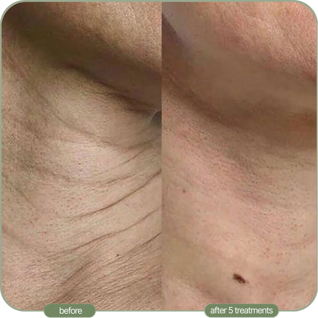 Ditch The Make-up: Embrace a New Level of Confidence with Micro-Infusion